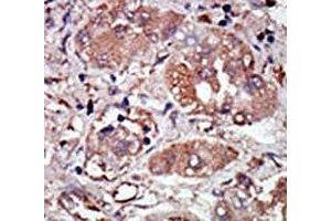 IHC analysis of FFPE human hepatocarcinoma stained with the PRKR antibody (EIF2AK2 抗体  (AA 519-550))
