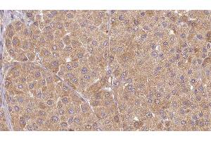 ABIN6277525 at 1/100 staining Human Melanoma tissue by IHC-P. (Urotensin 2 抗体  (C-Term))