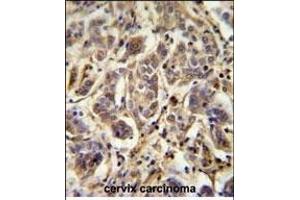 FL Antibody (C-term) (ABIN651674 and ABIN2840355) immunohistochemistry analysis in formalin fixed and paraffin embedded human cervix carcinoma followed by peroxidase conjugation of the secondary antibody and DAB staining. (AAGAB 抗体  (C-Term))