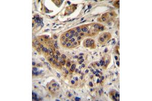 ACOX1 Antibody (N-term) A immunohistochemistry analysis in formalin fixed and paraffin embedded human bladder carcinoma followed by peroxidase conjugation of the secondary antibody and DAB staining. (ACOX1 抗体  (N-Term))