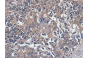 Detection of NT-ProBNP in Human Prostate cancer Tissue using Polyclonal Antibody to N-Terminal Pro-Brain Natriuretic Peptide (NT-ProBNP)