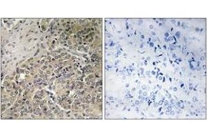 Immunohistochemistry analysis of paraffin-embedded human prostate carcinoma, using A26C2/3 Antibody. (A26C2/3 (AA 401-450) 抗体)
