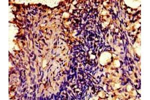 Immunohistochemistry of paraffin-embedded human ovarian cancer using ABIN7175412 at dilution of 1:100 (AVPR2 抗体  (AA 221-271))