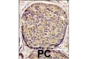 Formalin-fixed and paraffin-embedded human prostata carcinoma tissue reacted with PI3KCB antibody (C-term), which was peroxidase-conjugated to the secondary antibody, followed by DAB staining. (PI3KCB (AA 713-744), (C-Term) 抗体)