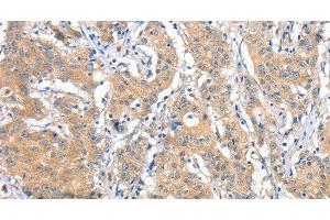 Immunohistochemistry of paraffin-embedded Human gastric cancer tissue using ANKMY2 Polyclonal Antibody at dilution 1:30 (ANKMY2 抗体)