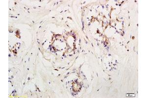 Formalin-fixed and paraffin embedded human breast carcinoma labeled with Anti LIFR/CD118 Polyclonal Antibody, Unconjugated (ABIN686827) at 1:200 followed by conjugation to the secondary antibody and DAB staining (LIFR 抗体  (AA 451-580))