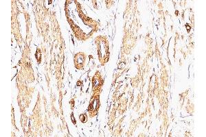 Formalin-fixed, paraffin-embedded human Leiomyosarcoma stained with Smooth Muscle Actin Mouse Monoclonal Antibody (SPM332). (Smooth Muscle Actin 抗体  (N-Term))