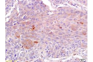 Formalin-fixed and paraffin embedded human lung carcinoma labeled with Anti-ADAMTS4 Polyclonal Antibody, Unconjugated (ABIN755173) at 1:200 followed by conjugation to the secondary antibody and DAB staining. (ADAMTS4 抗体  (AA 501-839))