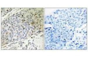 Immunohistochemistry analysis of paraffin-embedded human breast carcinoma tissue, using RMP antibody. (URI1 抗体  (C-Term))