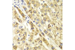 Immunohistochemistry of paraffin-embedded human liver cancer using CTBP1 antibody at dilution of 1:100 (400x lens). (CTBP1 抗体)