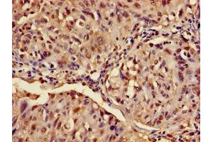 Immunohistochemistry of paraffin-embedded human lung cancer using ABIN7144793 at dilution of 1:100 (Ataxin 3 抗体  (AA 1-288))