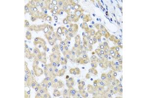 Immunohistochemistry of paraffin-embedded human liver injury using RAB24 antibody (ABIN5974578) at dilution of 1/100 (40x lens). (RAB24 抗体)