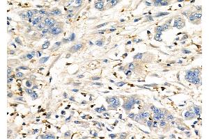ABIN6260576 and ABIN6276962 at 1/100 staining Human gastric cancer by IHC-P. (CD151 抗体  (N-Term))