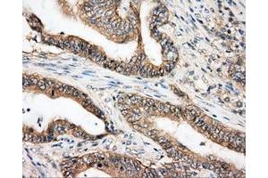 Immunohistochemical staining of paraffin-embedded Carcinoma of liver tissue using anti-BTK mouse monoclonal antibody. (BTK 抗体)