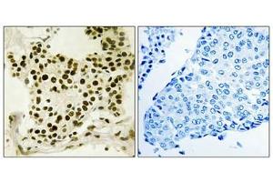 Immunohistochemistry analysis of paraffin-embedded human breast carcinoma tissue using UBF (Phospho-Ser484) antibody. (UBTF 抗体  (pSer484))