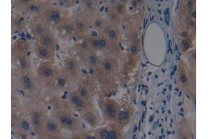 Detection of MAP3K1 in Human Liver cancer Tissue using Polyclonal Antibody to Mitogen Activated Protein Kinase Kinase Kinase 1 (MAP3K1) (MAP3K1 抗体  (AA 1307-1509))