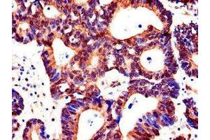 Immunohistochemistry of paraffin-embedded human colon cancer using ABIN7143200 at dilution of 1:100 (ACSF2 抗体  (AA 42-615))