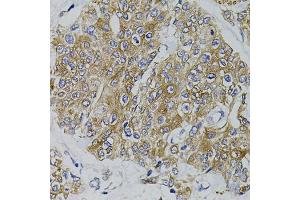 Immunohistochemistry of paraffin-embedded human prostate cancer using ARHGEF11 antibody (ABIN5995407) (40x lens). (ARHGEF11 抗体)