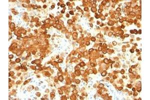 Immunohistochemistry (IHC) image for anti-Premelanosome Protein (PMEL) antibody (ABIN3024235)