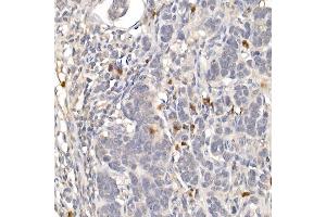 Immunohistochemistry of paraffin-embedded human colon carcinoma using NUR77 Rabbit pAb (ABIN6132395, ABIN6144826, ABIN6144829 and ABIN6222380) at dilution of 1:100 (40x lens). (NR4A1 抗体  (AA 1-170))