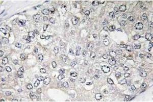 Immunohistochemistry (IHC) analyzes of p-p70 S6 kinase alpha antibody in paraffin-embedded human breast carcinoma tissue. (RPS6KB1 抗体  (pThr444))