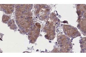ABIN6272763 at 1/100 staining Human liver cancer tissue by IHC-P. (OR52N5 抗体  (C-Term))