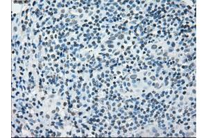 Immunohistochemical staining of paraffin-embedded Adenocarcinoma of colon tissue using anti-PRKYmouse monoclonal antibody. (PRKY 抗体)