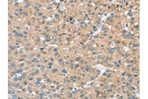 The image on the left is immunohistochemistry of paraffin-embedded Human liver cancer tissue using ABIN7192685(STK32C Antibody) at dilution 1/20, on the right is treated with synthetic peptide. (STK32C 抗体)