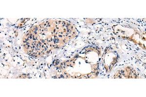 Immunohistochemistry of paraffin-embedded Human cervical cancer tissue using C16orf45 Polyclonal Antibody at dilution of 1:45(x200) (C16orf45 抗体)