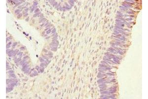 Immunohistochemistry of paraffin-embedded human ovarian cancer using ABIN7163403 at dilution of 1:100 (PHKG2 抗体  (AA 237-406))