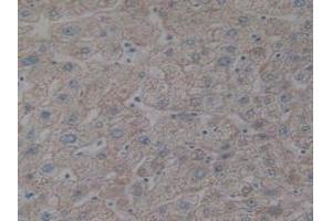 Detection of IkBb in Human Prostate Gland Cancer Tissue using Polyclonal Antibody to Inhibitory Subunit Of NF Kappa B Beta (IkBb) (NFKBIB 抗体  (AA 85-332))