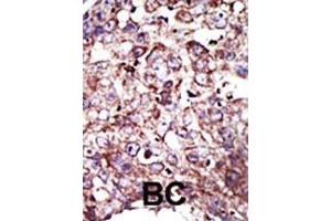 Formalin-fixed and paraffin-embedded human cancer tissue reacted with the primary antibody, which was peroxidase-conjugated to the secondary antibody, followed by DAB staining. (FNTA 抗体  (C-Term))