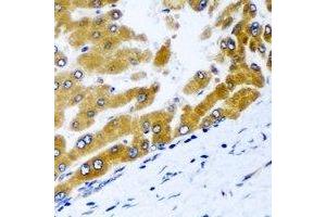Immunohistochemical analysis of GPD2 staining in human liver cancer formalin fixed paraffin embedded tissue section. (GPD2 抗体)