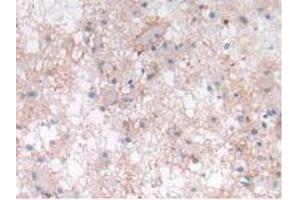 IHC-P analysis of Human Glioma Tissue, with DAB staining. (LIF 抗体  (AA 2-201))