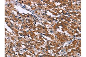 The image on the left is immunohistochemistry of paraffin-embedded Human thyroid cancer tissue using ABIN7192381(SKI Antibody) at dilution 1/40, on the right is treated with synthetic peptide. (SKI 抗体)