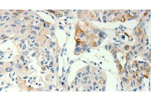 Immunohistochemistry of paraffin-embedded Human lung cancer tissue using TRPA1 Polyclonal Antibody at dilution 1:60 (TRPA1 抗体)