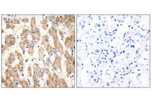 Immunohistochemistry analysis of paraffin-embedded human liver carcinoma tissue, using BAX antibody. (BAX 抗体  (Internal Region))