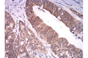 Immunohistochemical analysis of paraffin-embedded rectum cancer tissues using ASH2L mouse mAb with DAB staining. (ASH2L 抗体  (AA 493-628))