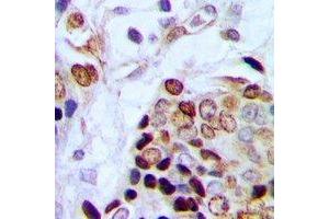 Immunohistochemical analysis of TAF15 staining in human prostate cancer formalin fixed paraffin embedded tissue section. (TAF15 抗体)