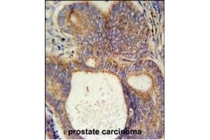 LYSMD1 Antibody (C-term) (ABIN651931 and ABIN2840459) immunohistochemistry analysis in formalin fixed and paraffin embedded human prostate carcinoma followed by peroxidase conjugation of the secondary antibody and DAB staining. (LYSMD1 抗体  (C-Term))