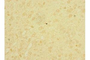 Immunohistochemistry of paraffin-embedded human glioma using ABIN7158206 at dilution of 1:100 (Lrig1 抗体  (AA 35-220))