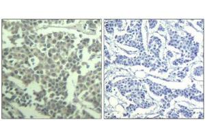 Immunohistochemical analysis of paraffin-embedded human breast carcinoma tissue using c-kit(Phospho-Tyr936) Antibody(left) or the same antibody preincubated with blocking peptide(right). (KIT 抗体  (pTyr936))
