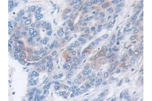 Detection of MMP3 in Human Liver cancer Tissue using Monoclonal Antibody to Matrix Metalloproteinase 3 (MMP3)