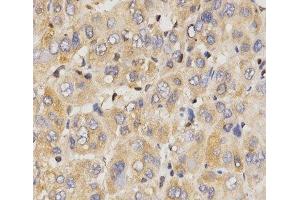Immunohistochemistry of paraffin-embedded Human liver cancer using Eif2ak2 Polyclonal Antibody at dilution of 1:200 (40x lens).