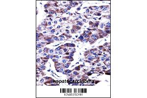 DUSP9 Antibody immunohistochemistry analysis in formalin fixed and paraffin embedded human hepatocarcinoma followed by peroxidase conjugation of the secondary antibody and DAB staining. (DUSP9 抗体  (C-Term))