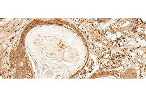 Immunohistochemistry of paraffin-embedded Human esophagus cancer tissue using FIZ1 Polyclonal Antibody at dilution of 1:35(x200)