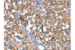 The image on the left is immunohistochemistry of paraffin-embedded Human thyroid cancer tissue using ABIN7190040(CACNA1G Antibody) at dilution 1/20, on the right is treated with synthetic peptide. (CACNA1G 抗体)