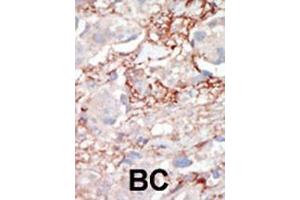 Formalin-fixed and paraffin-embedded human cancer tissue reacted with the primary antibody, which was peroxidase-conjugated to the secondary antibody, followed by AEC staining. (STK3 抗体  (C-Term))