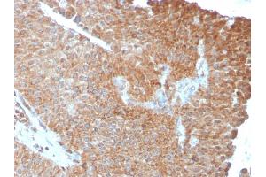 Formalin-fixed, paraffin-embedded human Urothelial Carcinoma stained with PAI-RBP1 Mouse Monoclonal Antibody (SERBP1/3493).