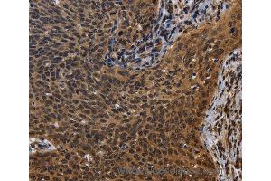Immunohistochemistry of Human colon cancer using FHL3 Polyclonal Antibody at dilution of 1:40 (FHL3 抗体)